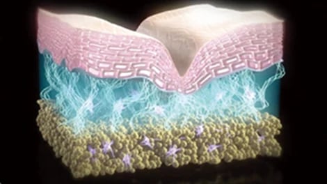 Skin cutaway with a central crease, a blue fibrous layer and deeper yellow tissue.