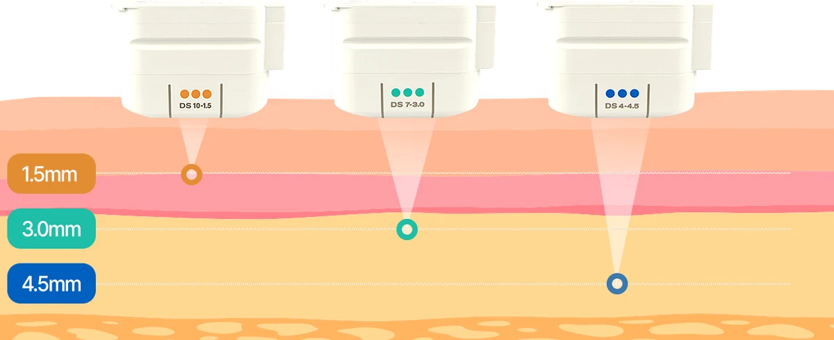 Three ultrasound treatment heads above a tissue cross-section, with focal points labelled 1.5 mm, 3.0 mm and 4.5 mm.