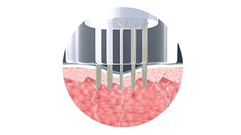 Circular skin cross-section with a microneedle tip and needles entering the tissue.