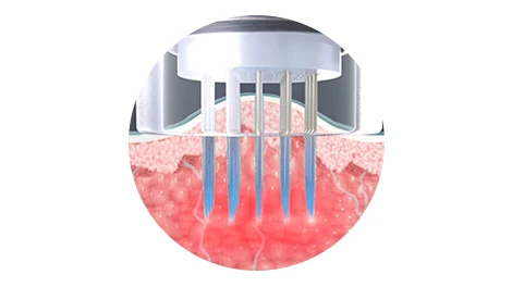 Microneedle skin illustration with blue columns extending through the tissue beneath the tip.