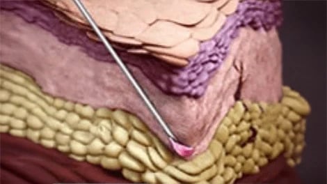 Skin cutaway showing a needle tip and pink material near the boundary above yellow fatty tissue.