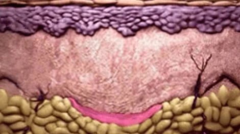 Skin section with a pink band along the boundary between the thicker skin layer and yellow fat.