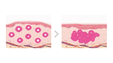 Two skin diagrams joined by an arrow, with scattered pink rings on the left and clustered pink forms on the right.