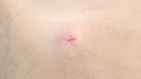 Close photograph of a small reddish skin mark with faint surrounding discoloration.