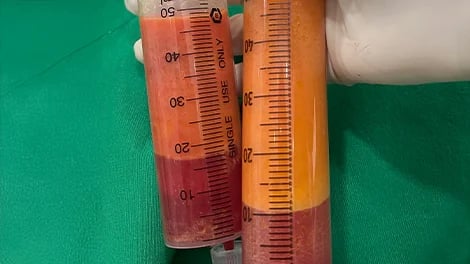 Two graduated syringes containing yellow-orange material and darker red fluid on a green drape.