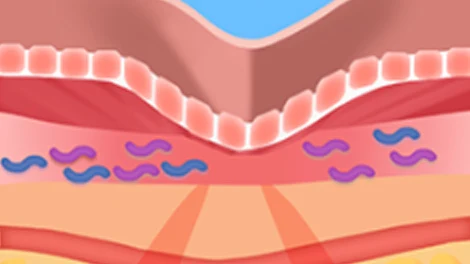 Pink skin section with a central depression and scattered blue and purple fibres beneath it.