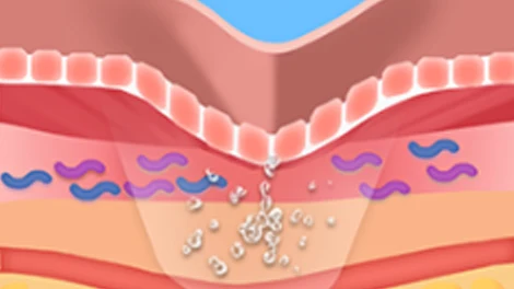 Skin section with a central crease and small pale particles inside a translucent area.