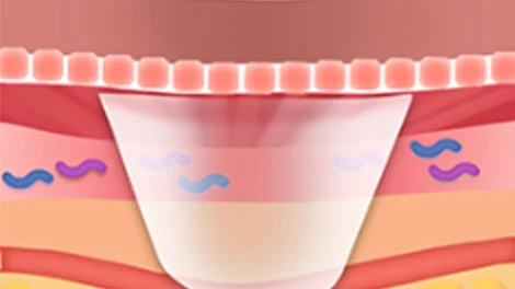 Skin section with a level surface above a broad translucent area within the tissue.