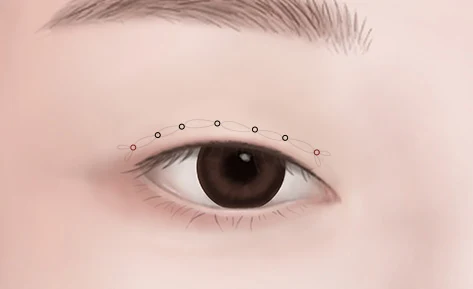 Eyelid illustration showing connections between the marked points.