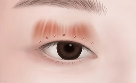 Illustration of the eyelid fixation points and internal connection.