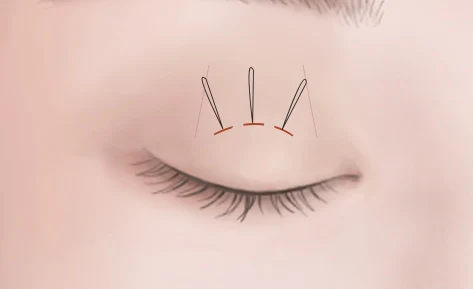 Closed eyelid illustration with small openings and suture paths.