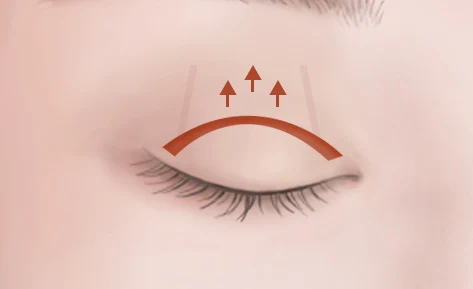Closed eyelid illustration with a curved incision line and upward arrows.