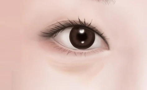 Front-view eye illustration showing fullness and shadowing beneath the lower eyelid.