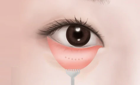 Lower-eyelid illustration showing the inner surface exposed with an instrument.